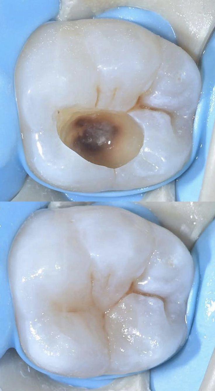Obturation temporaire sans préparation cavitaire
